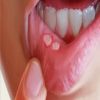 6 علاجات طبيعية منزلية لعلاج تقرحات الفم