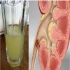 8 خطوات لعلاج حصوات الكلى دون تدخل جراحى