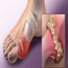 علاج النقرس بالأدوية وأسباب حدوثه