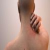 احذر من الجرب فى الشتاء .. اعرف سبب الإصابة وطرق العلاج