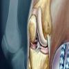علاج التهاب المفاصل بالادوية والعلاجات الطبيعية