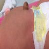 الفتق الإربى.. أسبابه وأعراضه وعلاجه