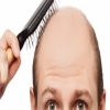 أسباب الصلع.. أهمها العامل النفسى 