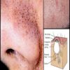 4 طرق للتخلص من الحبوب السوداء