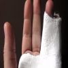 قبل الجبس.. 10 طرق منزلية بسيطة للتعامل مع الكسور